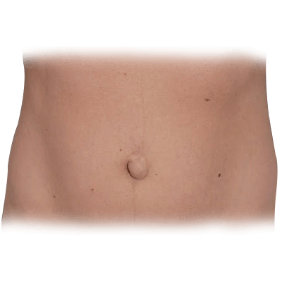 abdominal hernia in adults