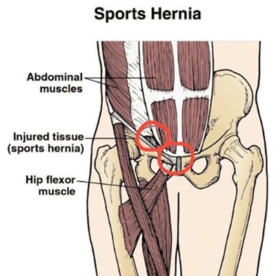 A Complete Guide On Sports Hernia