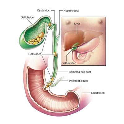 gallbladder disease diagram